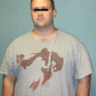 Compare Before & After Photos of _procedure_photos.phpGastric Bypass Surgery