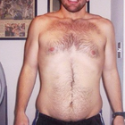 Compare Before & After Photos of _procedure_photos.phpGastric Band Surgery