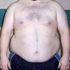 Compare Before & After Photos of _procedure_photos.phpGastric Band Surgery