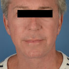 Compare Before & After Photos of _procedure_photos.phpFat Transfer