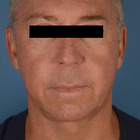 Compare Before & After Photos of _procedure_photos.phpFat Transfer