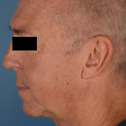 Compare Before & After Photos of _procedure_photos.phpFat Transfer