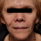 Compare Before & After Photos of _procedure_photos.phpFat Transfer