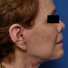 Compare Before & After Photos of _procedure_photos.phpFat Transfer