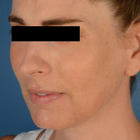 Compare Before & After Photos of _procedure_photos.phpFat Transfer