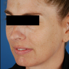 Compare Before & After Photos of _procedure_photos.phpFat Transfer