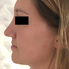 Compare Before & After Photos of _procedure_photos.phpFat Transfer