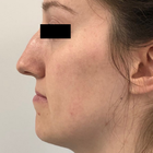 Compare Before & After Photos of _procedure_photos.phpFat Transfer