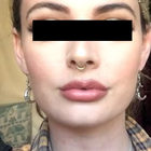 Compare Before & After Photos of _procedure_photos.phpLip Augmentation