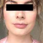 Compare Before & After Photos of _procedure_photos.phpLip Augmentation