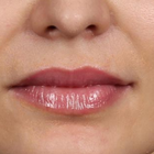 Compare Before & After Photos of _procedure_photos.phpLip Augmentation