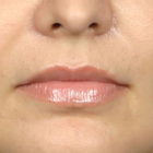Compare Before & After Photos of _procedure_photos.phpLip Augmentation
