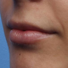 Compare Before & After Photos of _procedure_photos.phpLip Augmentation