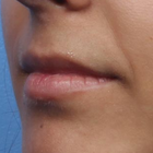 Compare Before & After Photos of _procedure_photos.phpLip Augmentation
