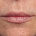 Compare Before & After Photos of _procedure_photos.phpLip Augmentation