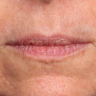 Compare Before & After Photos of _procedure_photos.phpLip Augmentation