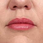 Compare Before & After Photos of _procedure_photos.phpLip Augmentation