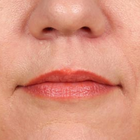 Compare Before & After Photos of _procedure_photos.phpLip Augmentation