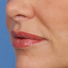 Compare Before & After Photos of _procedure_photos.phpLip Augmentation