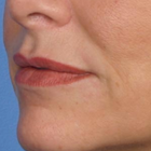 Compare Before & After Photos of _procedure_photos.phpLip Augmentation