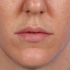 Compare Before & After Photos of _procedure_photos.phpLip Augmentation
