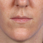 Compare Before & After Photos of _procedure_photos.phpLip Augmentation