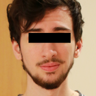 Compare Before & After Photos of _procedure_photos.phpSex Reassignment Surgery (Female To Male)