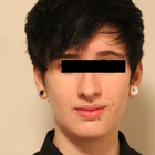 Compare Before & After Photos of _procedure_photos.phpSex Reassignment Surgery (Female To Male)