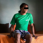 Compare Before & After Photos of _procedure_photos.phpSex Reassignment Surgery (Female To Male)