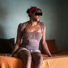 Compare Before & After Photos of _procedure_photos.phpSex Reassignment Surgery (Female To Male)