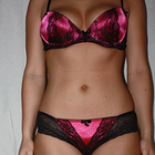 Compare Before & After Photos of _procedure_photos.phpVaser-Liposuction