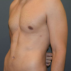Compare Before & After Photos of _procedure_photos.phpVaser-Liposuction