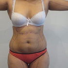 Compare Before & After Photos of _procedure_photos.phpVaser-Liposuction