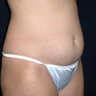 Compare Before & After Photos of _procedure_photos.phpVaser-Liposuction