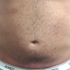 Compare Before & After Photos of _procedure_photos.phpVaser-Liposuction