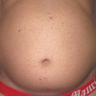 Compare Before & After Photos of _procedure_photos.phpVaser-Liposuction