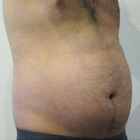 Compare Before & After Photos of _procedure_photos.phpVaser-Liposuction