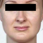 Compare Before & After Photos of _procedure_photos.phpMesotherapy