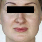 Compare Before & After Photos of _procedure_photos.phpMesotherapy