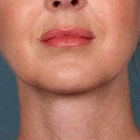 Compare Before & After Photos of _procedure_photos.phpMesotherapy