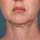 Compare Before & After Photos of _procedure_photos.phpMesotherapy