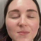 Compare Before & After Photos of _procedure_photos.phpMesotherapy