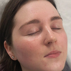 Compare Before & After Photos of _procedure_photos.phpMesotherapy