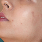 Compare Before & After Photos of _procedure_photos.phpMesotherapy