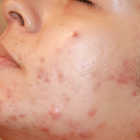 Compare Before & After Photos of _procedure_photos.phpMesotherapy