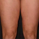 Compare Before & After Photos of _procedure_photos.phpMesotherapy