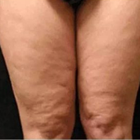 Compare Before & After Photos of _procedure_photos.phpMesotherapy