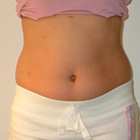 Compare Before & After Photos of _procedure_photos.phpMesotherapy