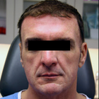 Compare Before & After Photos of _procedure_photos.phpStem Cell Therapy