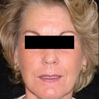 Compare Before & After Photos of _procedure_photos.phpStem Cell Therapy